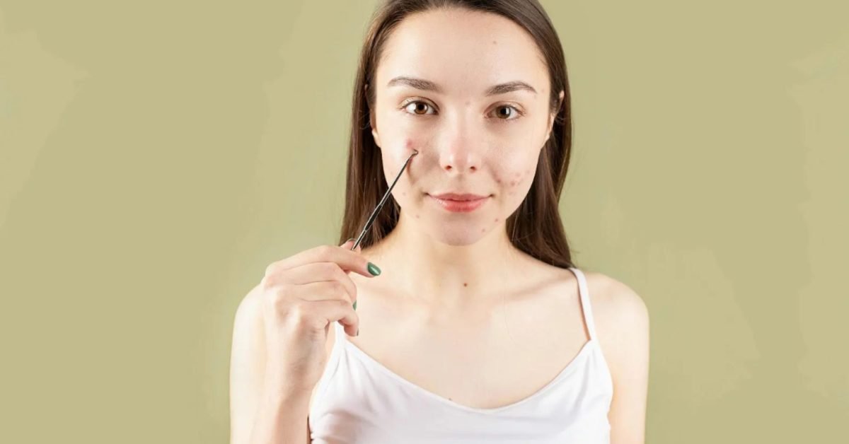 _Mjolnir Pro é eficaz contra a acne ativa e resistente